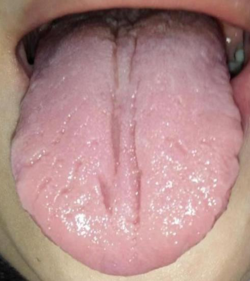 A clinical tongue sign along the midline — a Governor vessel correspondence